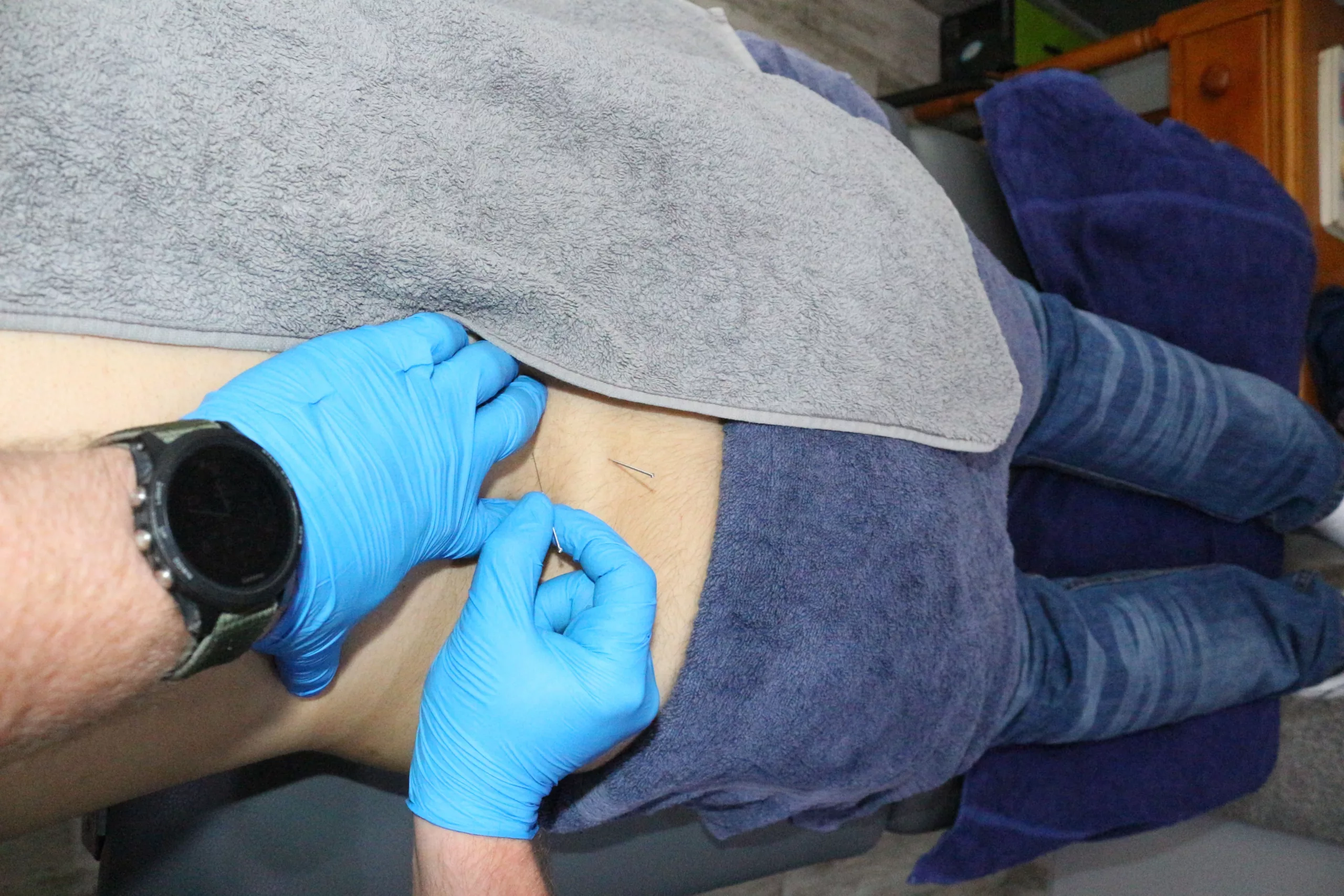 Dry Needling